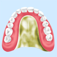 PGA床義歯